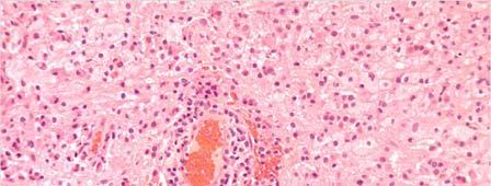 Polyarteritis nodosa necrotizing vasculitis Multiple sclerosis plaque Polyarteritis