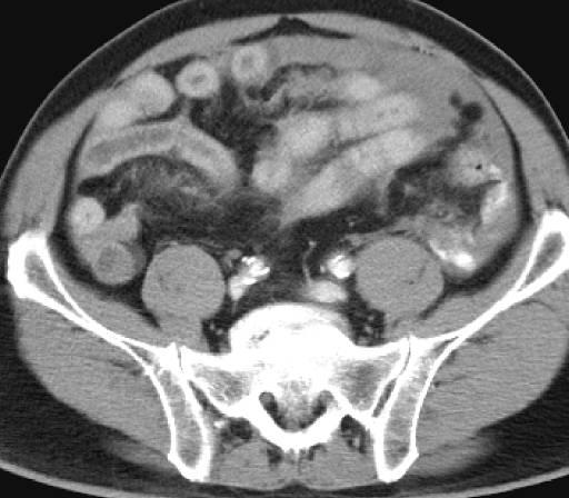 the only sign of injury to bowel/mesentery or solid organ (20%+) Larger amounts of fluid in