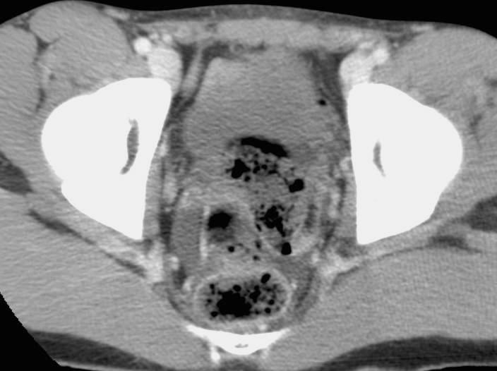 Pelvic Fluid: Male CT of Mesenteric Injury CT of Mesenteric Injury Active bleeding Hematoma Infiltration (misty, hazy)