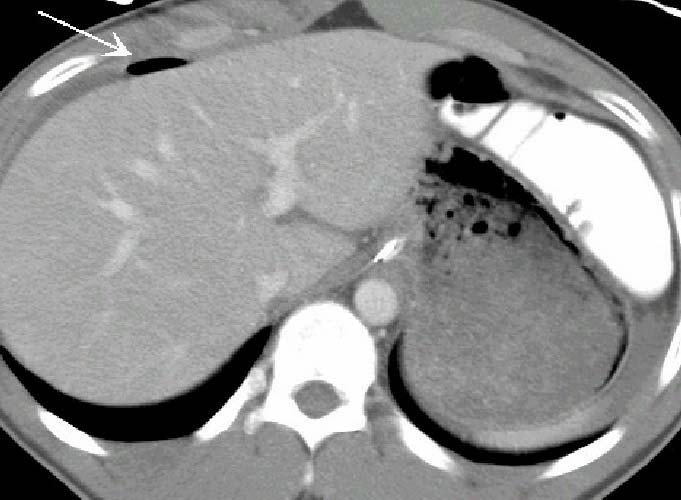 CT Pneumoperitoneum Consider other sources of air Look for free air beneath anterior abdominal wall, adjacent liver, porta hepatis, between bowel loops More cephalad air in