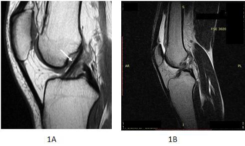 MM - Medial Meniscus. LM - Lateral Meniscus. OCD - Osteochondral Defects. IDK - Internal Derangement of Knee Joint. SPECT - Single Photon Emission Computed Tomography. Image 1.