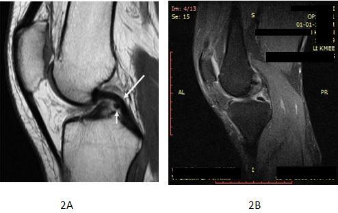 Sagittal Proton-Density Image of the Knee showing Intact PCL in Figure 2A and Complete Tear PCL in Figure 2B Remove the Patient and Institute Name from the Figure Image 3.