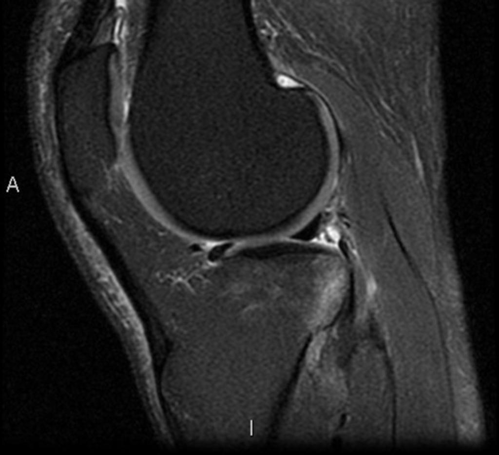 Fig. 9: Sagital T2 FAT SAT WI: bone contusions on the lateral femoral condile and tibia associated with a ACL injury. Fig.
