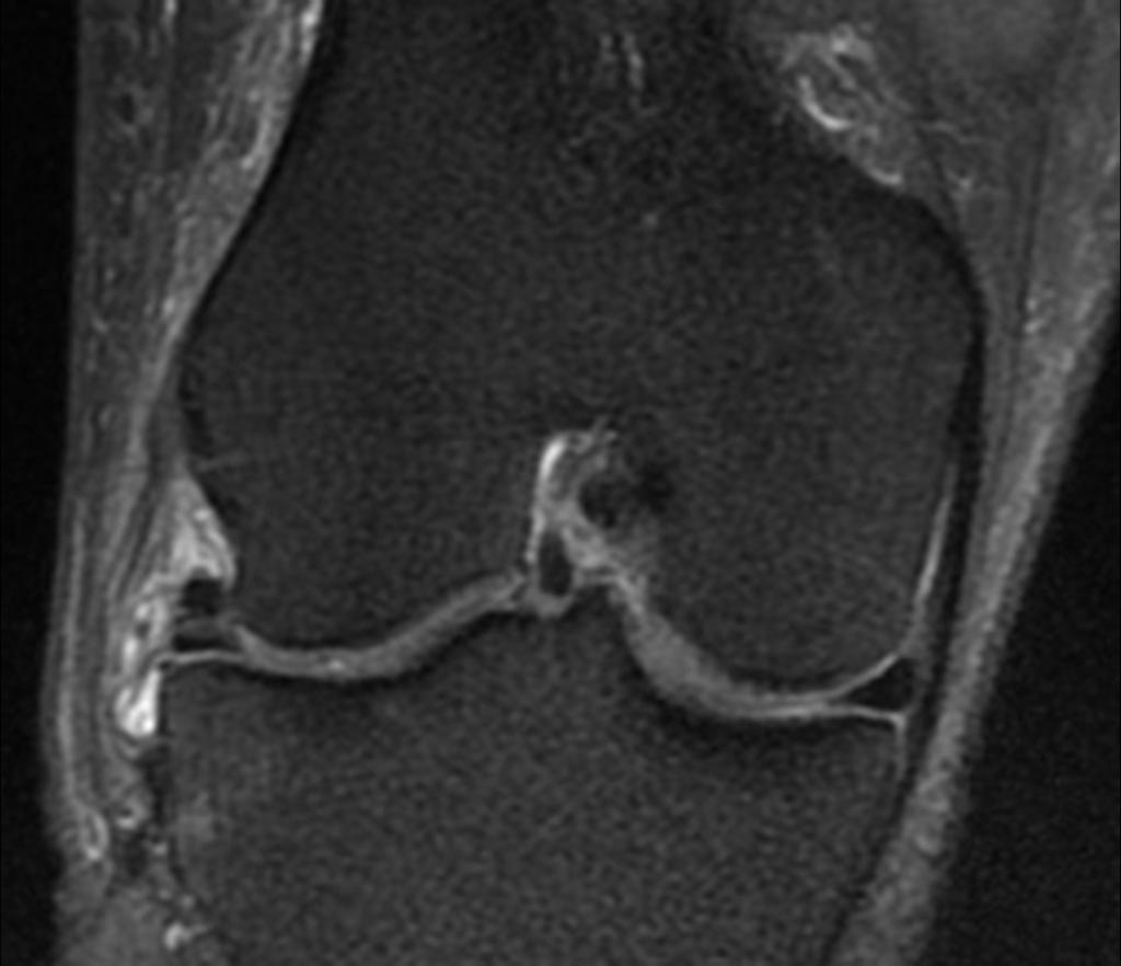 Fig. 13: Coronal DP FAT SAT WI: fibular colateral ligament