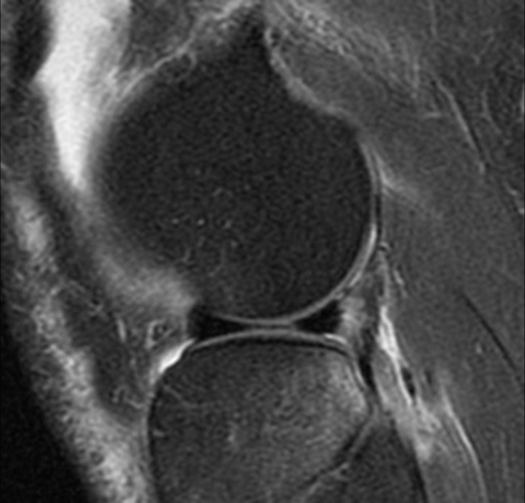 Fig. 14: Sagital DP FAT SAT WI: posterolateral corner injury with partial Rupture of the miotendinous junction of the popliteus tendon (thick