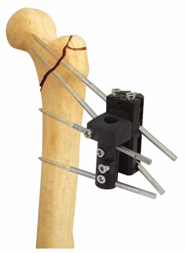 PERTROCHANTERIC FIXATOR DESCRIPTION SECTION OF EXTERNAL FIXATION SYSTEMS The Pertrochanteric External Fixator is designed to be used for the rapid stabilization of trochanteric fractures in high risk