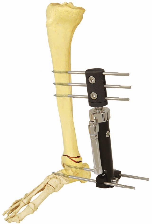SECTION OF EXTERNAL FIXATION SYSTEMS DYNAMIC AXIAL FIXATOR (DAF) WITH ANKLE CLAMP DESCRIPTION The Dynamic Axial External Fixator with Ankle Clamp is a fixator with ball-joint and it is used primarly