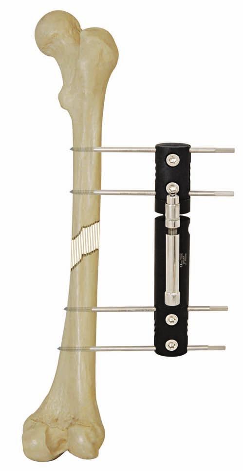 SECTION OF EXTERNAL FIXATION SYSTEMS LIMB LENGTHENER FIXATOR DESCRIPTION The Limb ener Fixator is designed for the treatment of acute and complex trauma or limb lengthening due to fresh fracture,