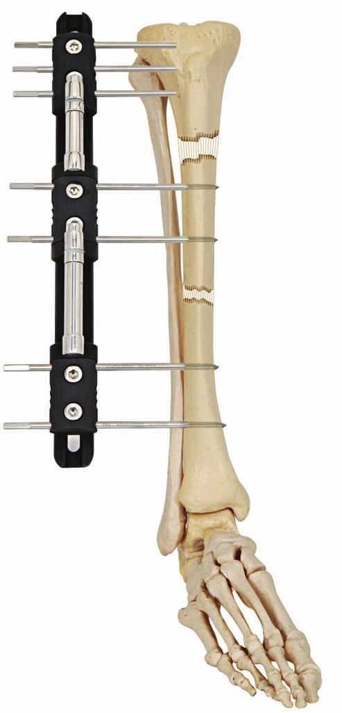 SECTION OF EXTERNAL FIXATION SYSTEMS LIMB RECONSTRUCTION FIXATOR (LRS) DESCRIPTION The Limb Reconstruction Fixator is designed for the treatment of limb reconstruction and lengthening due to fresh