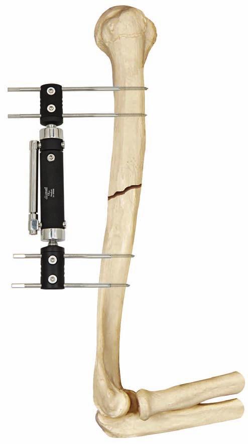 SECTION OF EXTERNAL FIXATION SYSTEMS HUMERAL DYNAMIC AXIAL FIXATOR (PDAF) DESCRIPTION The Humeral Dynamic Axial External Fixator is a fixator with ball-joint and it is used primarly in acute trauma.