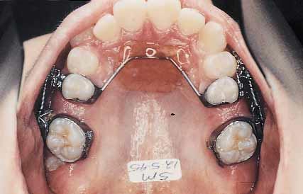530 Brickman, Sinha, and Nanda American Journal of Orthodontics and Dentofacial Orthopedics November 2000 1.95 ± 1.86 mm. The maxillary premolars extruded 1.57 ± 2.39 mm.