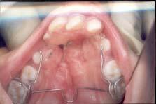 3: Intra-oral Front