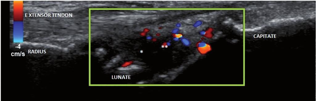 Fig. 1. US image showing the wrist of a patient with rheumatoid arthritis. *synovial hypertrophy and **positive power Doppler signal.