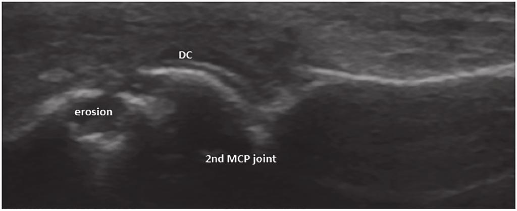 Fig. 2. US image of 2 nd MCP showing a cortical defect consistent with erosion and a double contour (DC) sign in a patient with gout. Fig. 3.