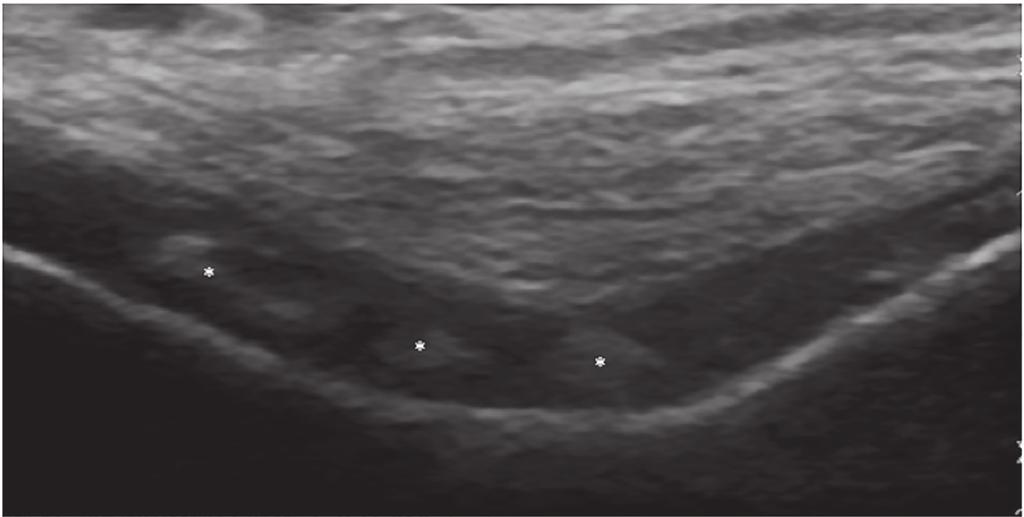 Fig. 4. *Hyperechoic deposits seen within the articular cartilage of the knee in a patient with chondrocalcinosis. ing to 4 of the minimum of 8 required points for gout classification (29).