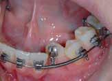 tooth. Activation with the steel spring is low, the tube from is retained and mucosa or scar tissue is easily repelled.