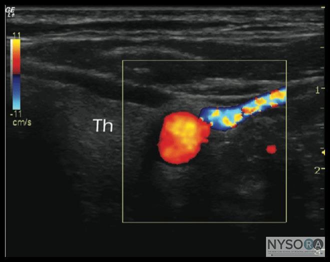 Doppler mode Produces a color-coded map of Doppler shifts superimposed onto a B-mode ultrasound image Blood flow direction depends on whether the motion