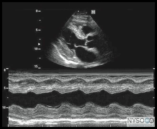 M mode A single beam in an ultrasound scan can be used to produce a picture with a motion