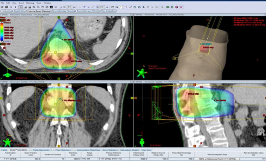 Case Study: Example of a Complete Abscopal Response DARRT Pa3ent with metastadc castrate-resistant prostate cancer. Being treated with pallia3ve radiotherapy for spinal lesions.