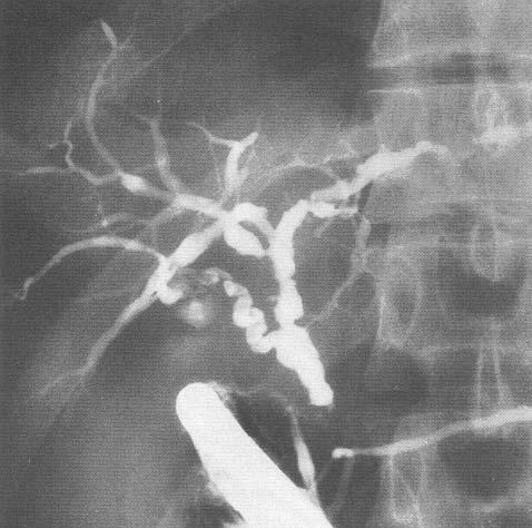 Imaging Dominant stricture of biliary tree less common in children ERCP and MRCP are both safe in children with equal performance