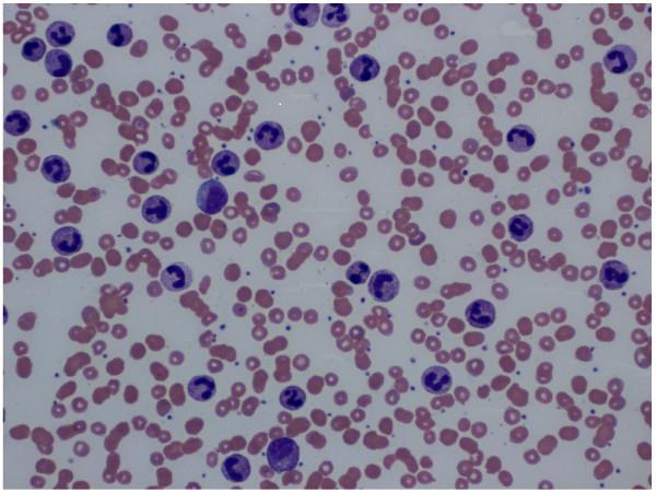 Leucocytosis Leucocytosis does not mean haematological malignancy Careful history Fevers, diarrhoea, drugs, smoking Examine Skin, liver, spleen, lymph nodes Ask