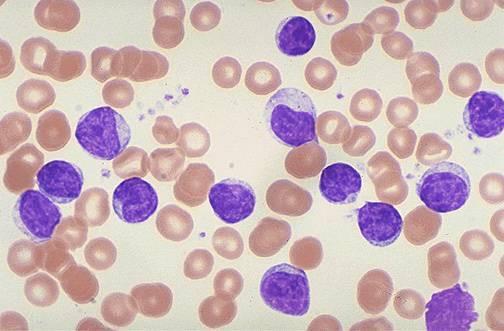 Lymphocytosis Lymphocyte Count Investigation >10 x 10 9 /L Refer to haematology for investigation >3.5 and <10 x 10 9 /L Rest of blood count normal No lymphadenopathy or splenomegaly >3.