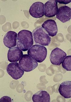C : Acute myeloid leukemia (AML);