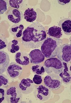 D : Chronic myeloid leukemia (CML);