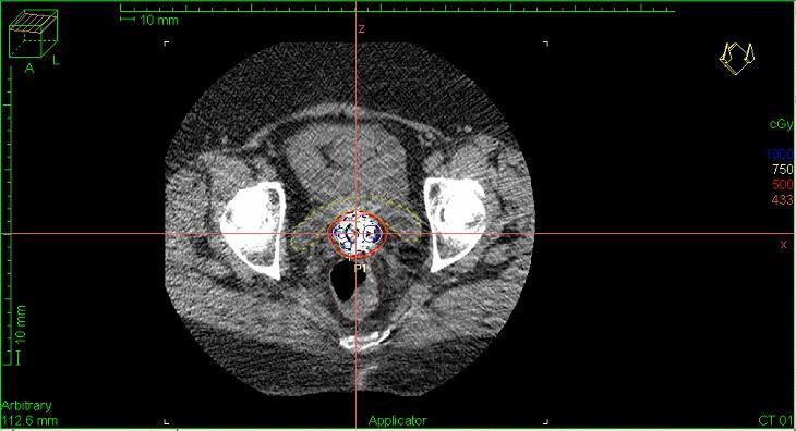 Figure 13. This image was obtained by editing a screenshot of the Oncentra TPS. The "hottest spot" on the rectum is indicated by P1.