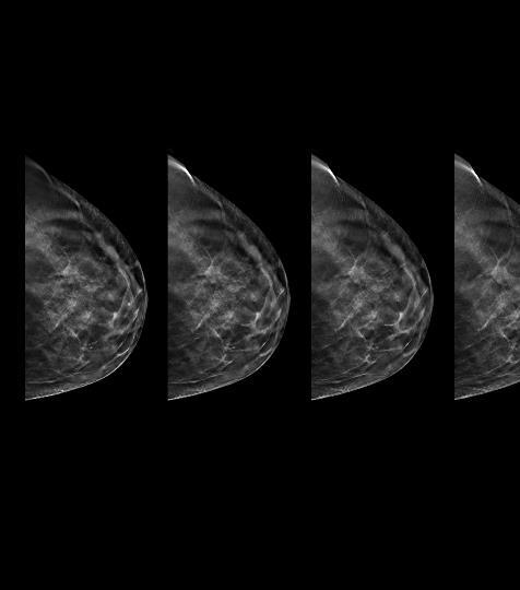 BREAST HEALTH SOLUTIONS Genius 3D MAMMOGRAPHY exams are clinically proven to detect 41% More invasive breast cancer, while simultaneously reducing unnecessary recalls up to 40% 1,2 1.