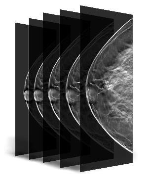 BREAST HEALTH SOLUTIONS Genius 3D MAMMOGRAPHY exams With Hologic technology, doctors can scroll through images of the breast like pages of a book.