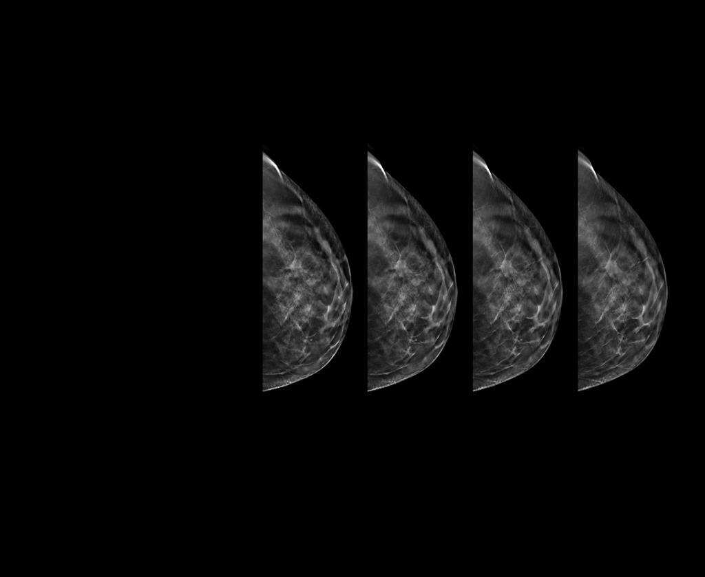 Genius 3D MAMMOGRAP HY exams have revolutionized breast