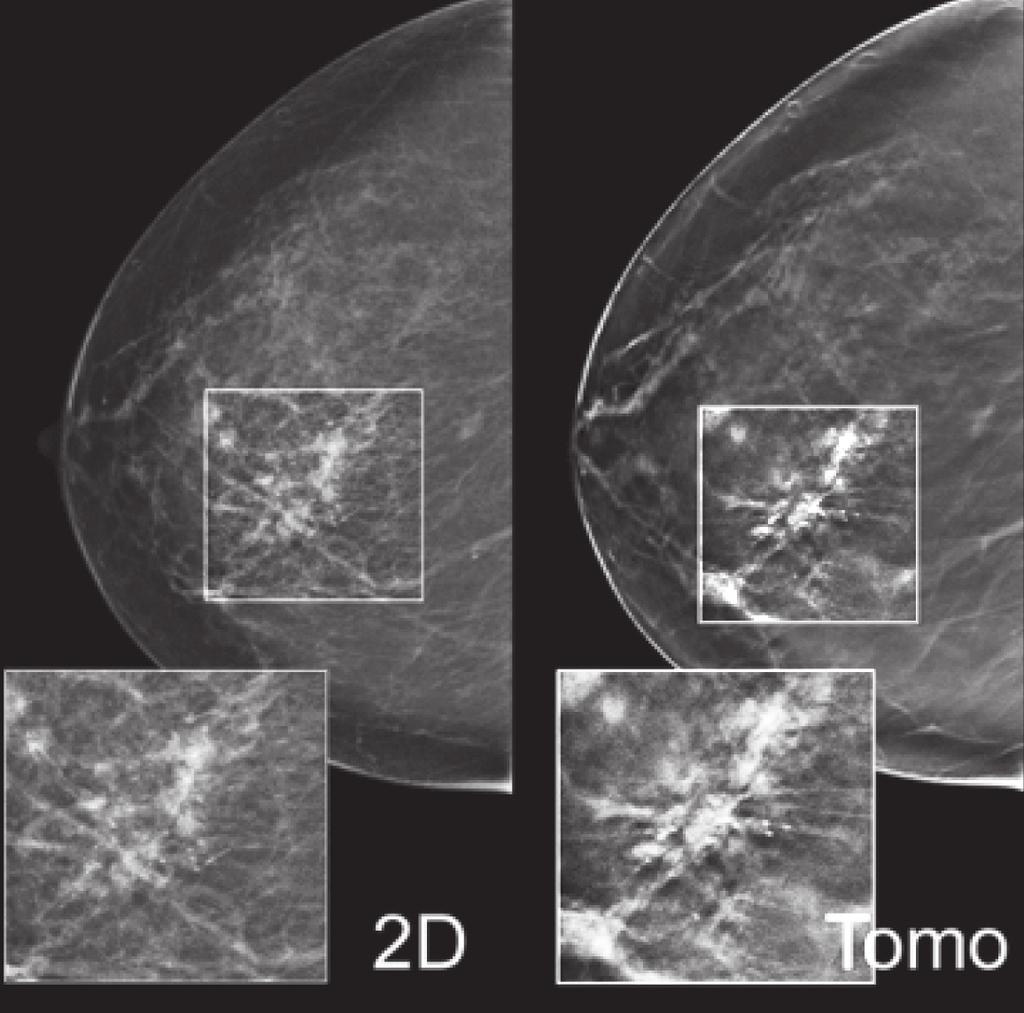 Figure 4: Increased cancer detection: the tomosynthesis reconstructed slice shown on the right reveals a definitive spiculated mass that is only