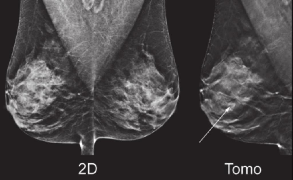 (Diagnosis: Invasive Ductal Carcinoma) Figure 5: Added value for calcifi cations: the 2D mammogram on the left shows right medial microcalcifi