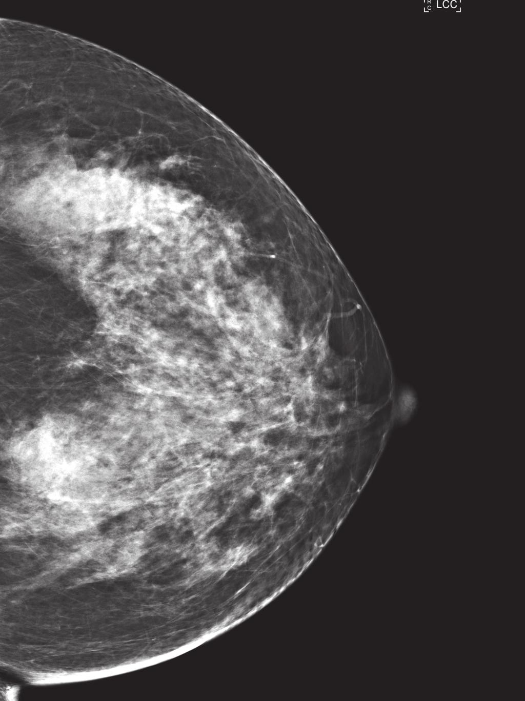 Figure 7: The 3D breast tomosynthesis shows a well defined mass on the