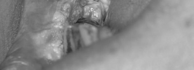 portion near the right mouth angle