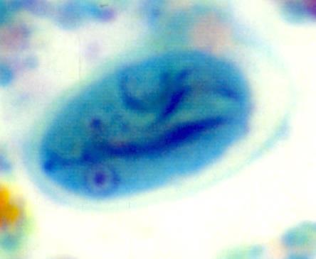 Giardia lamblia (cyst) Fragments of