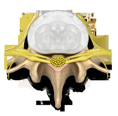 Advanced degenerative disc disease (DDD) may lead to degenerative spondylolisthesis when the spinal bones, discs, joints, and ligaments degenerate and become less able to maintain the alignment of
