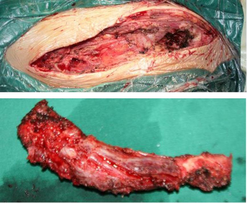 Lin et al. MC Musculoskeletal Disorders 2014, 15:183 Page 4 of 6 Figure 2 Intraoperative photograph.. Resection of clavicle length. Resected specimen.