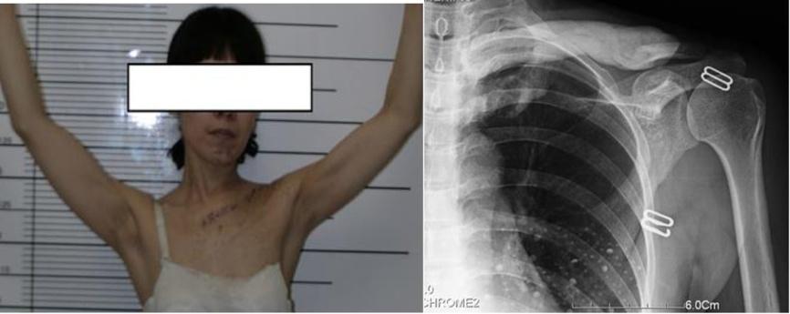 Lin et al. MC Musculoskeletal Disorders 2014, 15:183 Page 5 of 6 Figure 4 Shoulder outline and X-ray of postoperation. : Post-operative shoulder outline and functional display.