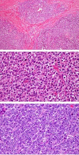 DUX4 Copy in Some Tumors Due to