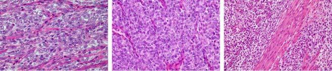 promyelocytic leukemia BCOR-ZC3H7B