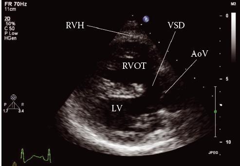 Adel Hasanin Ahmed 4 AORTIC COARCTATION Aortic coarctation is a narrowing of the aorta that most commonly occurs just distal to the origin of the left subclavian artery.