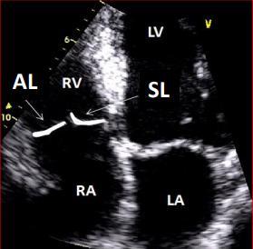 Adel Hasanin Ahmed 6 EBSTEIN S ANOMALY In Ebstein s anomaly the tricuspid valve (specifically the septal and posterior leaflets) is displaced towards the RV apex.