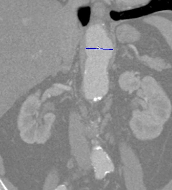 Problem: Dilated Thoracic Aorta