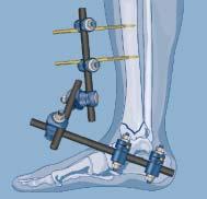 Clinical Solutions Foot and Ankle Plates and Screws External Fixation LCP Distal Fibula Plates Posterolateral and lateral distal fibula plates