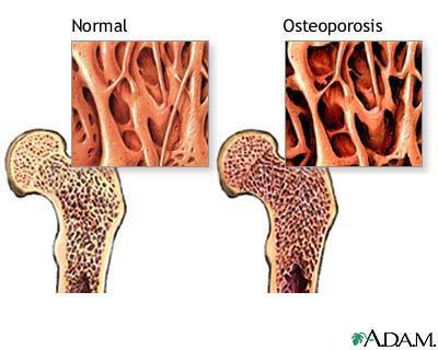 EXERCISE FOR OSTEOPOROSIS What is Osteoporosis? Osteoporosis is decreased bone density, or weak bones.