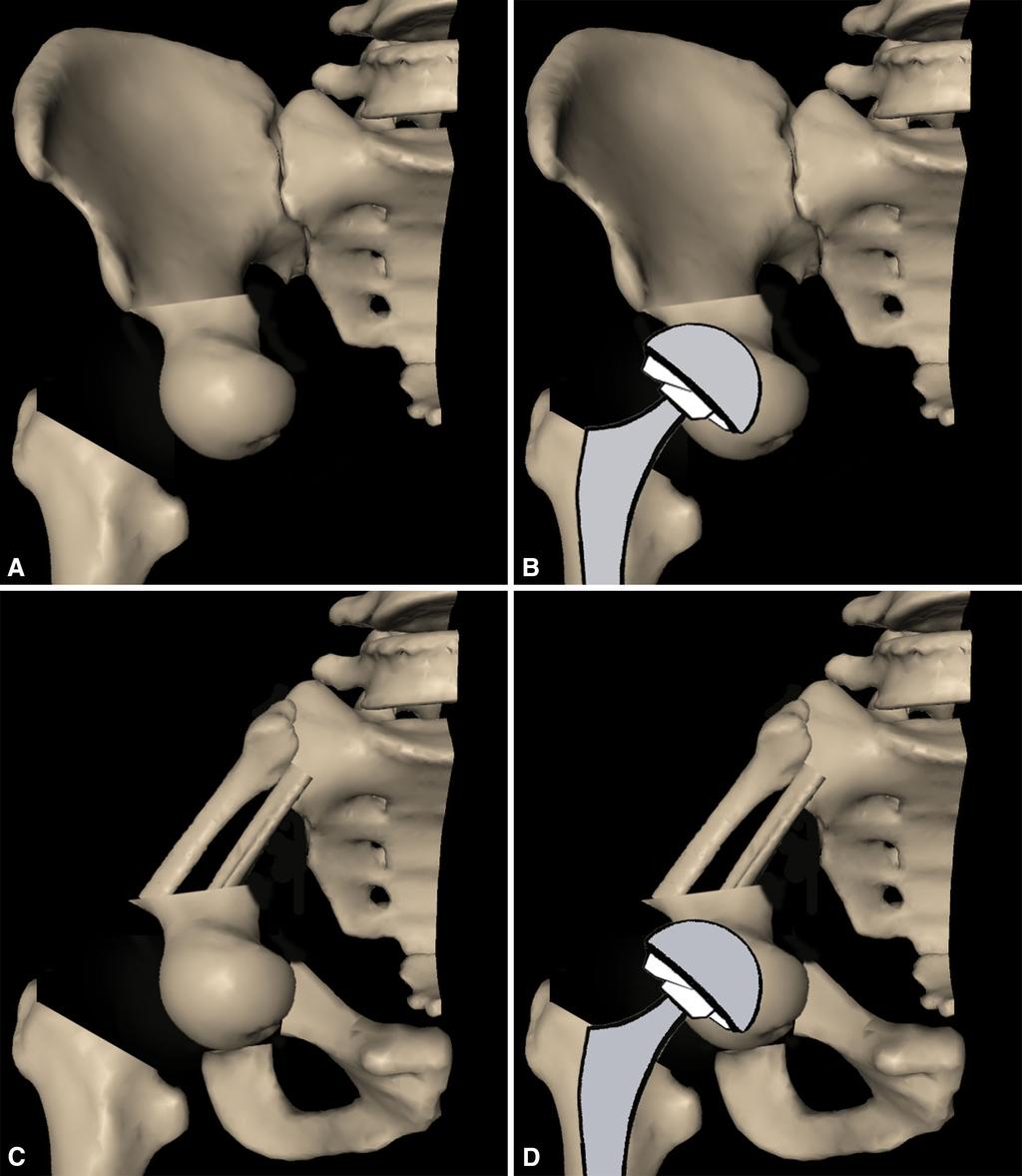 3064 Tang et al. Clinical Orthopaedics and Related Research 1 Fig. 2A D A pelvic reconstruction with an ipsilateral femoral head autograft is presented.