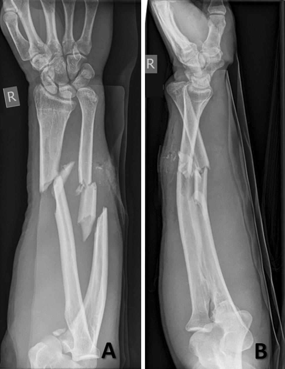 At the 12-month follow-up, the patient had Disabilities of the Arm, Shoulder and Hand (DASH) score of 10. X-rays and CT showed sufficient callus formation (Fig.