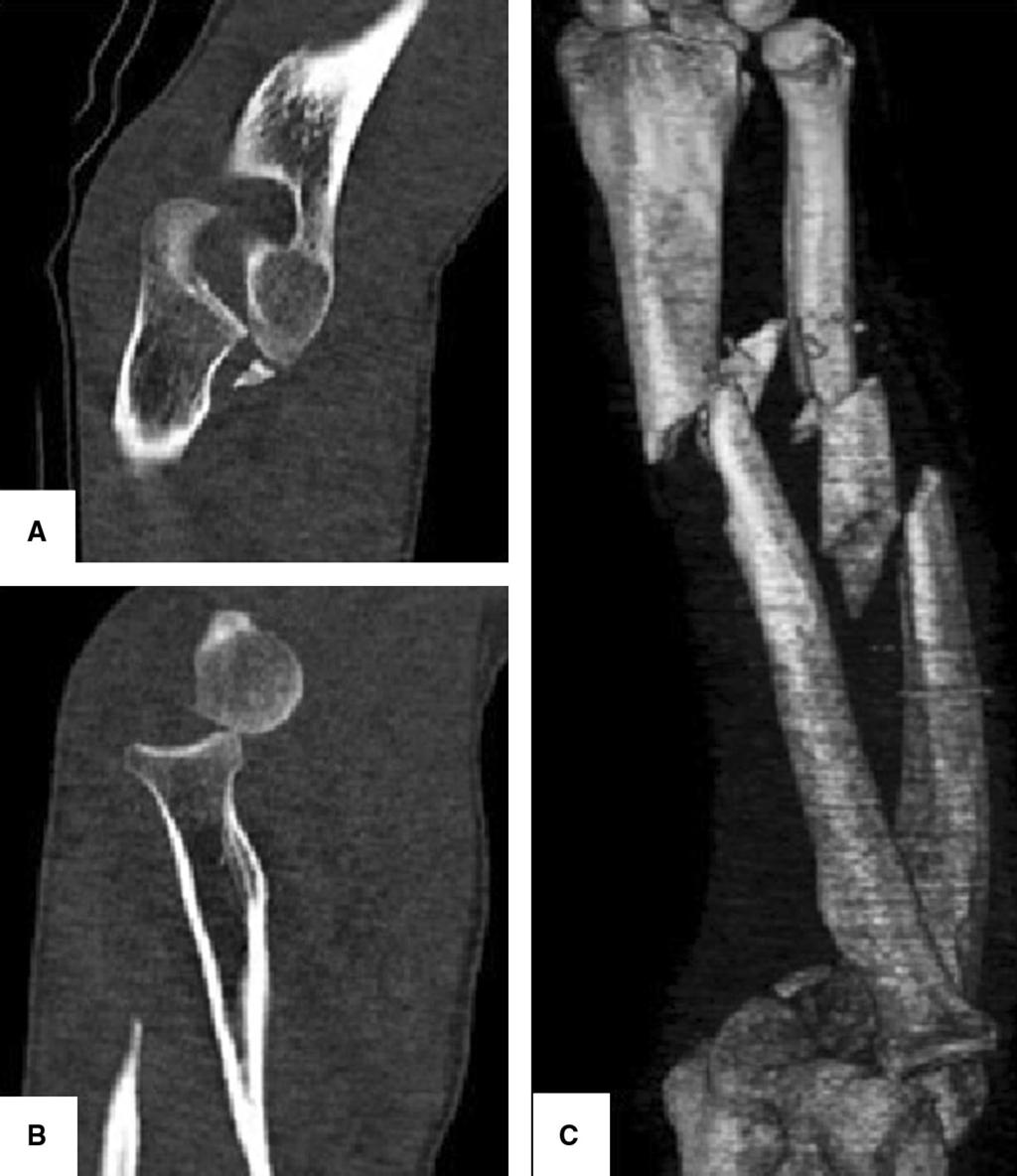 Fig. 2 Computed Tomography sagittal views of the injured elbow (a, b) and three-dimensional (3-D) reconstruction of the described injury (c) in the radial head is confirmed, while most adult